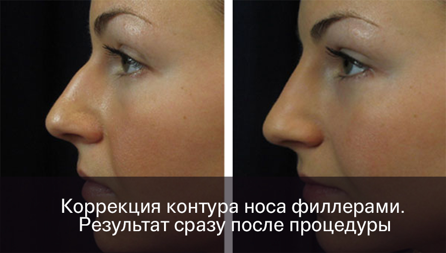 Картинка к: Безоперационная ринопластика в Никополе: корректируем нос без скальпеля и наркоза