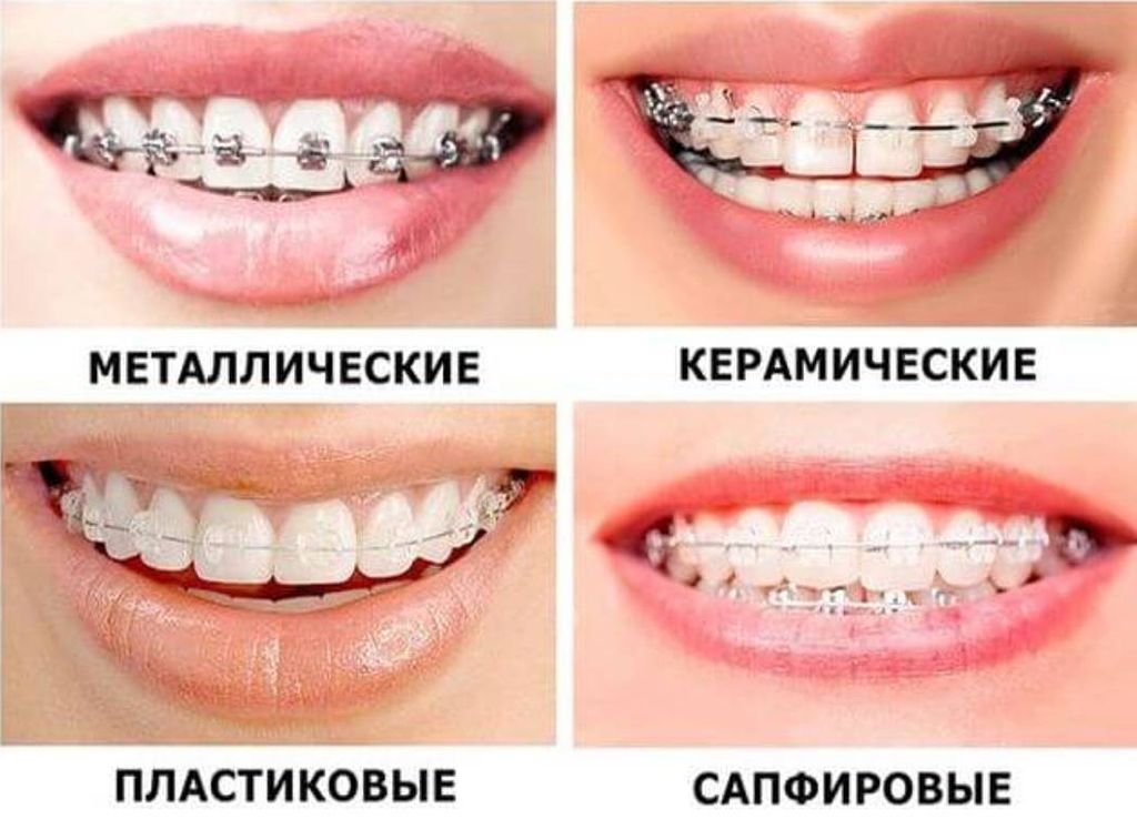 Картинка к: Важная информация для тех, кто хочет исправить прикус с помощью брекетов