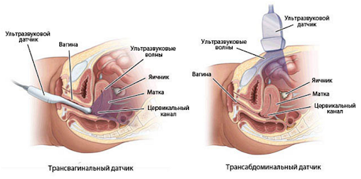 Картинка к: Для чего нужно узи органов малого таза