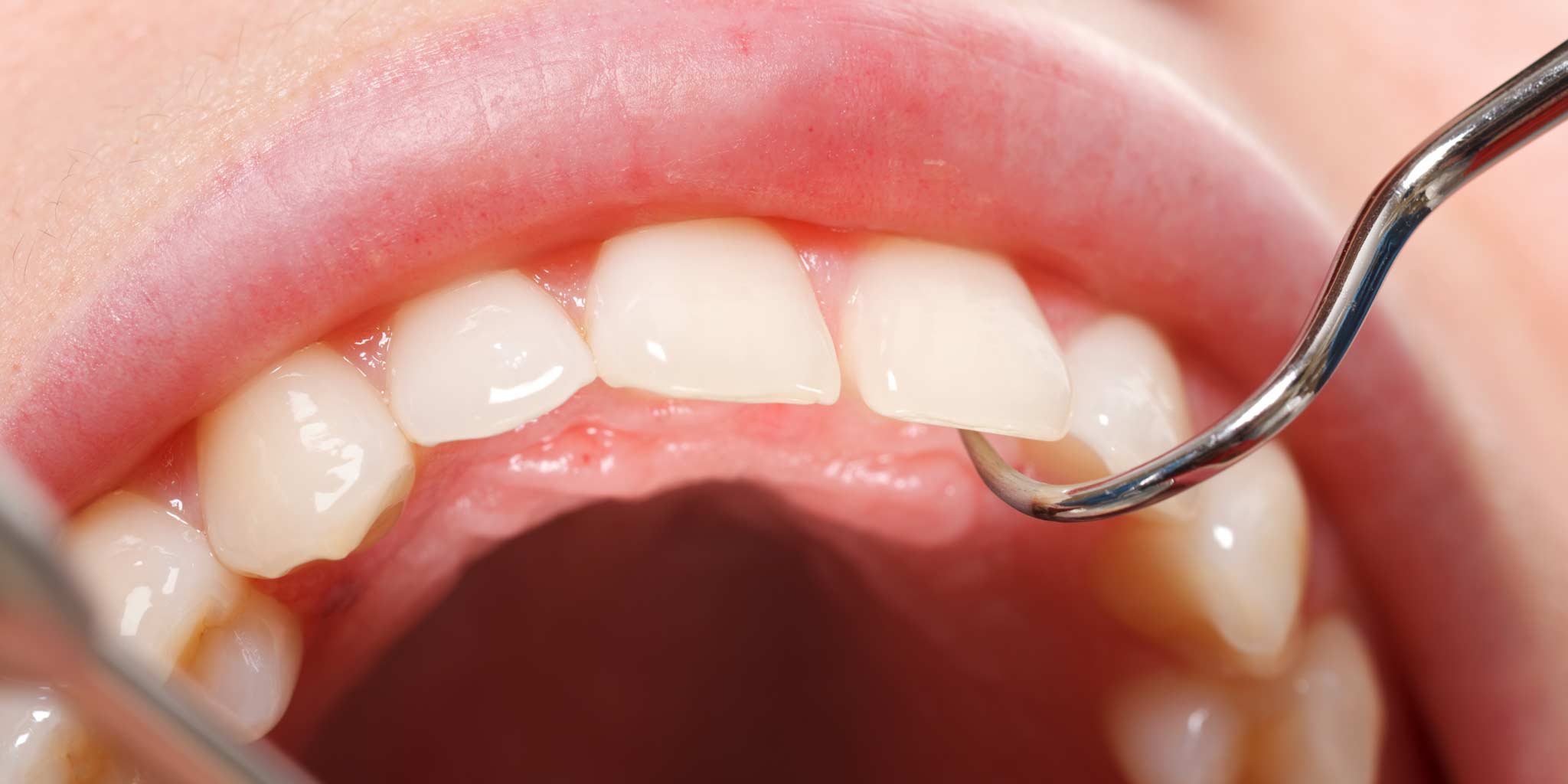 Картинка к: Заболевания и удаление зубов